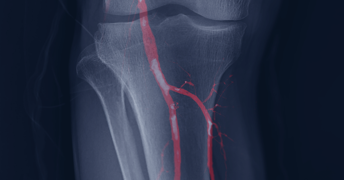 Genicular artery embolization is a minimally invasive procedure.